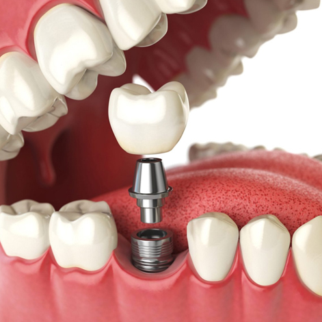 dental implants Greater Noida, tooth replacement Greater Noida, permanent tooth solution, advanced dental procedures, implant dentistry Greater Noida