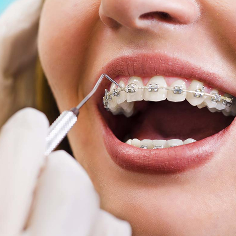 dental braces treatment Greater Noida, orthodontic solutions, teeth alignment Greater Noida, metal braces, ceramic braces, invisible aligners, orthodontic care Greater Noida